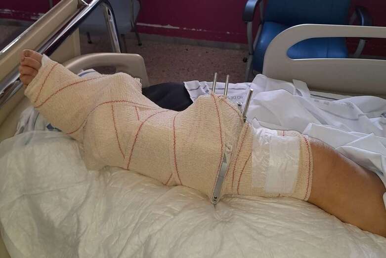 La pierna inmovilizada la vecina de Telde cuando estaba en el hospital/TA.